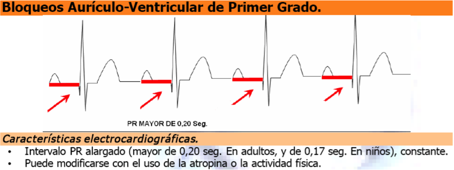 ECG 8.1 bloqueo AV de 1er grado